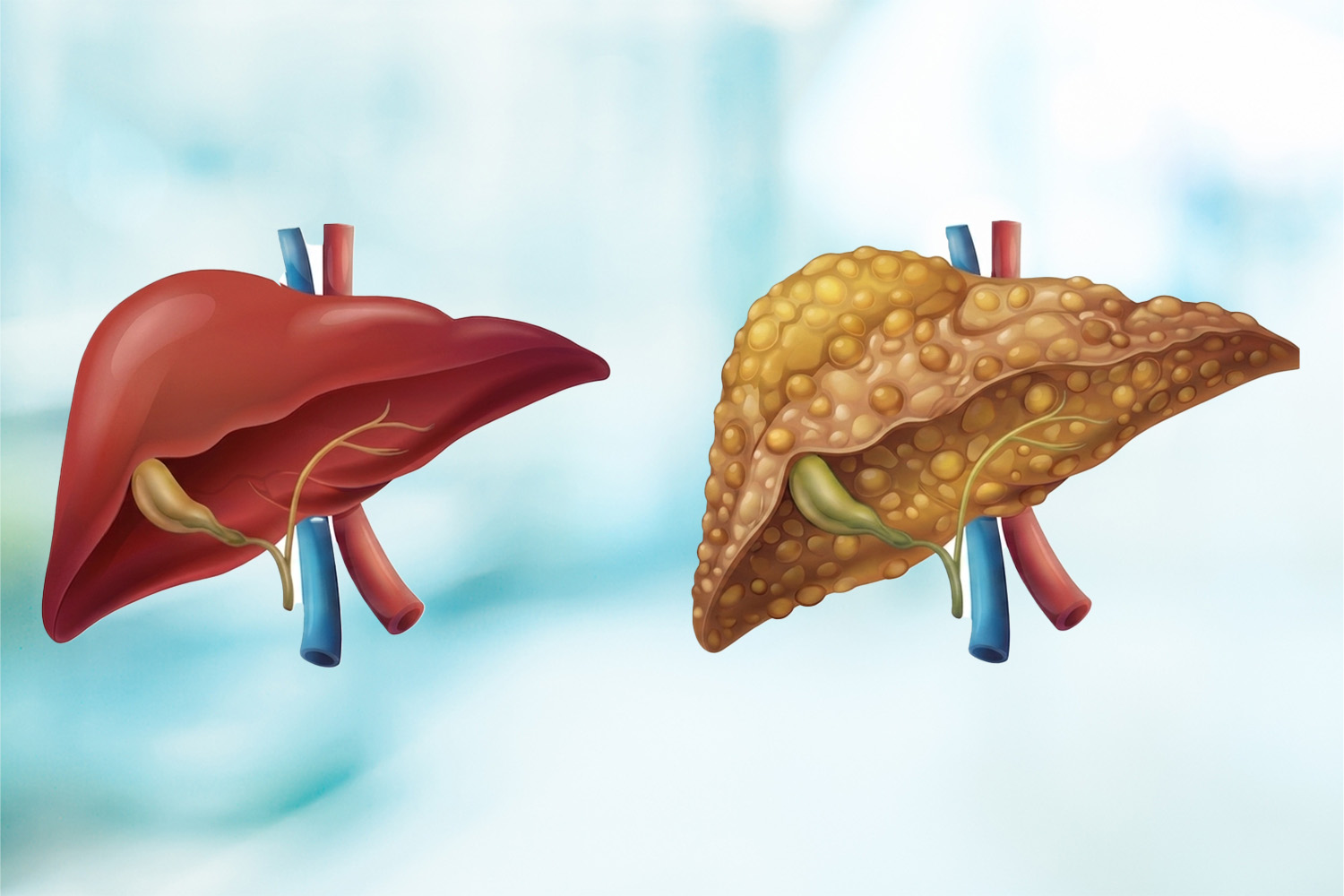 Fatty Liver Disease & Cirrhosis