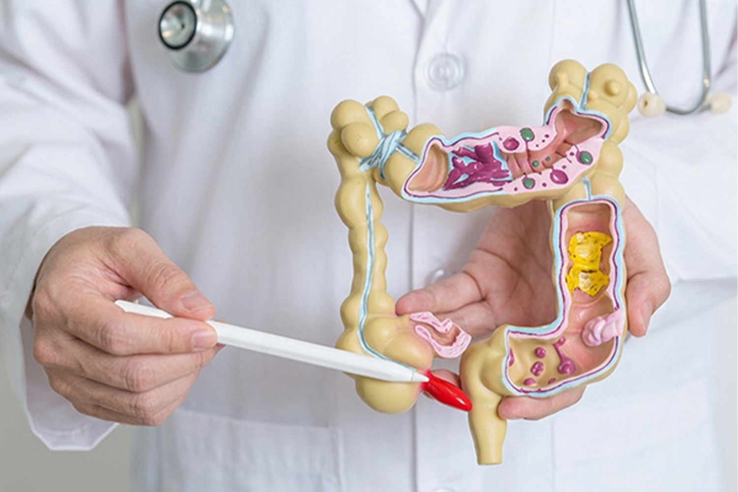 Inflammatory Bowel Disorder (IBD)