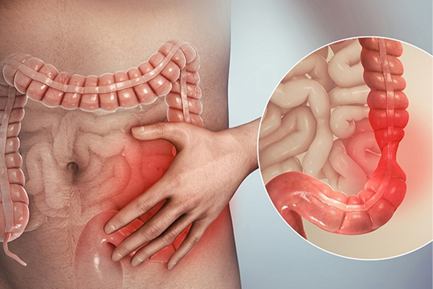 Irritable Bowel Syndrome (IBS)