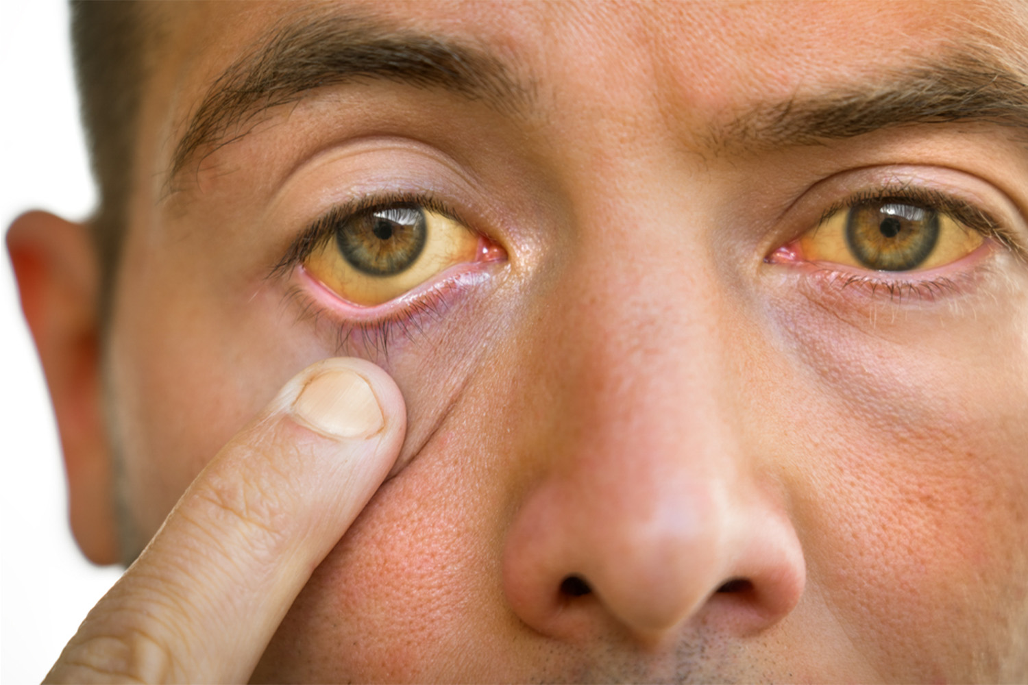 Jaundice & Hepatitis